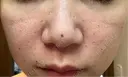水光注射（ハリ・美肌） エトワールレジーナクリニック新宿院 AFTER サムネイル用