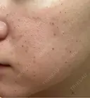 水光注射（ハリ・美肌） エトワールレジーナクリニック新宿院 DAY 1 サムネイル用