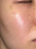 ピコスポット APスキンクリニック銀座 DAY 0 サムネイル用