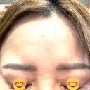 ボトックス（額） ルラ美容クリニック 郡山院 DAY 2 サムネイル用