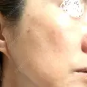 プラセンタ注射 / シミ取りレーザー S-Laboクリニック 渋谷院 AFTER サムネイル用