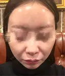 ピコレーザートーニング（美白・肝斑） / LDM・インテンスウルトラ Chloe Cheongdam Clinic （クロエチョンダムクリニック） DAY 0 サムネイル用