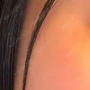 ほくろ・いぼ除去レーザー（肌） Fellez Clinic【フェルズクリニック】 AFTER サムネイル用