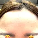 ボトックス（額） ルラ美容クリニック 郡山院 DAY 3 サムネイル用