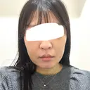 脂肪吸引注射（顔） 新宿美容外科ネビュラクリニック DAY 10 サムネイル用