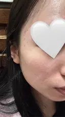 イオン導入 / 毛穴洗浄（ハイドラフェイシャルなど） RIN BEAUTY CLINIC DAY 1 サムネイル用