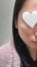 イオン導入 / 毛穴洗浄（ハイドラフェイシャルなど） RIN BEAUTY CLINIC DAY 4 サムネイル用