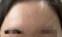 ボトックス（額） / ボトックス（バニーライン） / 医療脱毛（ワキ） ルラ美容クリニック 横浜院 AFTER サムネイル用
