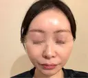 ピコレーザートーニング（美白・肝斑） / LDM・インテンスウルトラ Chloe Cheongdam Clinic （クロエチョンダムクリニック） AFTER サムネイル用