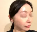 ピコレーザートーニング（美白・肝斑） / LDM・インテンスウルトラ Chloe Cheongdam Clinic （クロエチョンダムクリニック） DAY 1 サムネイル用