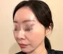 ピコレーザートーニング（美白・肝斑） / LDM・インテンスウルトラ Chloe Cheongdam Clinic （クロエチョンダムクリニック） DAY 1 サムネイル用