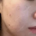 ルメッカ ルラ美容クリニック 郡山院 DAY 10 サムネイル用