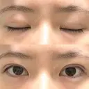 二重埋没 / 上まぶたの脂肪取り アリエル美容クリニック 郡山院 DAY 70 サムネイル用