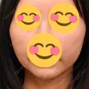 エレクトロポレーション / RF（高周波）たるみ治療 Days Beauty Clinic 新宿院 AFTER サムネイル用