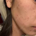 光治療（フォトフェイシャルなど） アクティブエイジクリニック DAY 4 サムネイル用