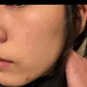 光治療（フォトフェイシャルなど） アクティブエイジクリニック AFTER サムネイル用