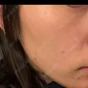 光治療（フォトフェイシャルなど） アクティブエイジクリニック DAY 8 サムネイル用