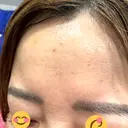 ボトックス（額） ルラ美容クリニック 郡山院 DAY 4 サムネイル用