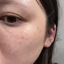 ルメッカ ルラ美容クリニック 岐阜院 AFTER サムネイル用