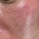 ダーマペン LE CLINIC DAY 0 サムネイル用