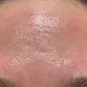 ダーマペン LE CLINIC DAY 0 サムネイル用