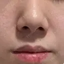 ルメッカ ルラ美容クリニック 郡山院 DAY 11 サムネイル用