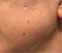 ピーリング（ハリ・ツヤ） / ルメッカ 小倉美容外科/美容皮膚科 ビラビューティークリニック DAY 1 サムネイル用