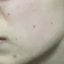 ほくろ・いぼ切除（肌） フローラクリニック AFTER サムネイル用