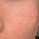 その他（目元） 品川スキンクリニック広島院 AFTER サムネイル用