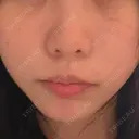 糸リフト / クマ治療 / 脂肪吸引（顔） / 下まぶたたるみ取り / 下まぶたの脂肪取り / ジョールファット除去 / 脂肪注入（目の下） / 脂肪吸引注射（顔） / ヒアルロン酸注入（あご） / ボトックス（エラ・小顔） SEA CLINIC（シークリニック） DAY 19 サムネイル用