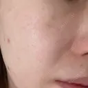 ルメッカ ルラ美容クリニック 郡山院 AFTER サムネイル用