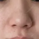 ルメッカ ルラ美容クリニック 郡山院 DAY 12 サムネイル用