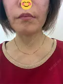 ヒアルロン酸注入（あご） / ヒアルロン酸注入（頬） / ヒアルロン酸注入（鼻翼基部） フローラクリニック AFTER サムネイル用