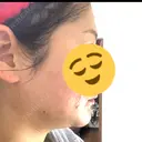インモード PureMe Skin Clinic（ピュアミースキンクリニック麻布） DAY 1 サムネイル用
