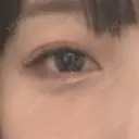 二重埋没 フローラクリニック AFTER サムネイル用