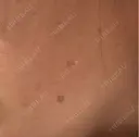 ピーリング（ハリ・ツヤ） / ルメッカ 小倉美容外科/美容皮膚科 ビラビューティークリニック DAY 2 サムネイル用