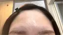 ボトックス（エラ・小顔） / ボトックス（口角） / ボトックス（肩） / ボトックス（眉間） / ボトックス（額） / ボトックス（人中） メディカルアルファクリニック DAY 0 サムネイル用