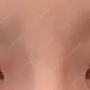 ほくろ・いぼ切除（肌） S-Laboクリニック 渋谷院 AFTER サムネイル用