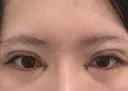 二重埋没 / 目頭切開 / 自然癒着法 Brandnew Beauty Clinic DAY 0 サムネイル用