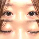 二重埋没 水の森美容クリニック 大阪梅田院 AFTER サムネイル用