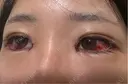二重埋没 / 目頭切開 / 目尻切開 / タレ目形成・グラマラスライン（切開） ziz CLINIC DAY 2 サムネイル用