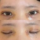 二重埋没 / 目頭切開 / 上まぶたの脂肪取り / ヒアルロン酸注入（涙袋） アリエル美容クリニック 郡山院 DAY 5 サムネイル用