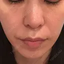 糸リフト / ボトックス（エラ・小顔） / ボトックス（額） / ボトックス（バニーライン） / ピコレーザートーニング（美白・肝斑） / ショッピングリフト APスキンクリニック銀座 AFTER サムネイル用