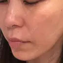 糸リフト / ボトックス（エラ・小顔） / ボトックス（額） / ボトックス（バニーライン） / ピコレーザートーニング（美白・肝斑） / ショッピングリフト APスキンクリニック銀座 DAY 67 サムネイル用