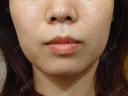 糸リフト / 脂肪吸引（顔） / あご下筋肉縛り LUHO（ルホ）美容外科 DAY 90 サムネイル用