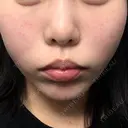 糸リフト / クマ治療 / 脂肪吸引（顔） / 下まぶたたるみ取り / 下まぶたの脂肪取り / ジョールファット除去 / 脂肪注入（目の下） / 脂肪吸引注射（顔） / ヒアルロン酸注入（あご） / ボトックス（エラ・小顔） SEA CLINIC（シークリニック） DAY 21 サムネイル用