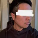 脂肪溶解注射（顔） 上野注入クリニック DAY 3 サムネイル用