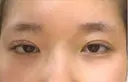 二重埋没 医療法人河田外科形成外科 DAY 3 サムネイル用