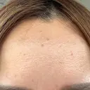 ボトックス（額） ルラ美容クリニック 郡山院 DAY 7 サムネイル用