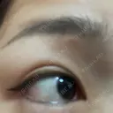 上まぶたの脂肪取り / 眉下切開 THE FIRST CLINIC 多摩センター院 AFTER サムネイル用